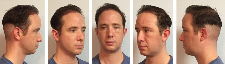 Dr. Lewis Hair Restoration