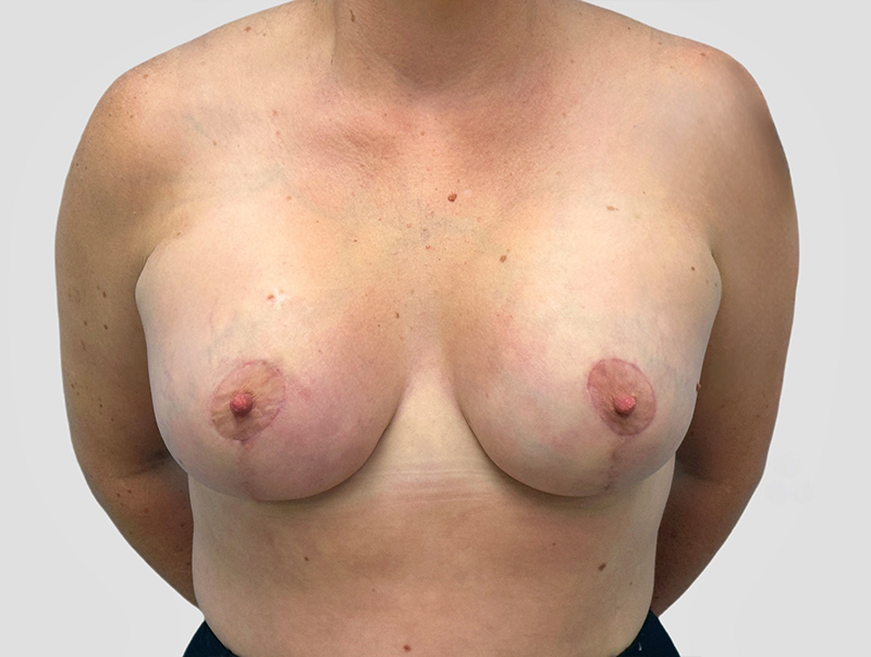 Breast Lift Before and After 09