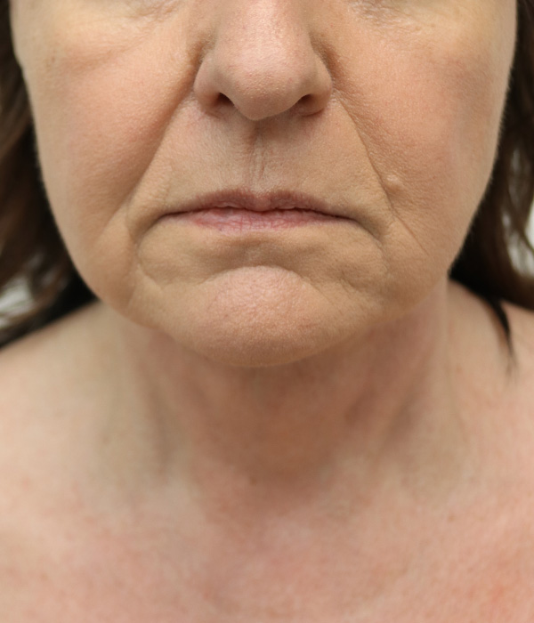 Facelift Necklift Before and After 01