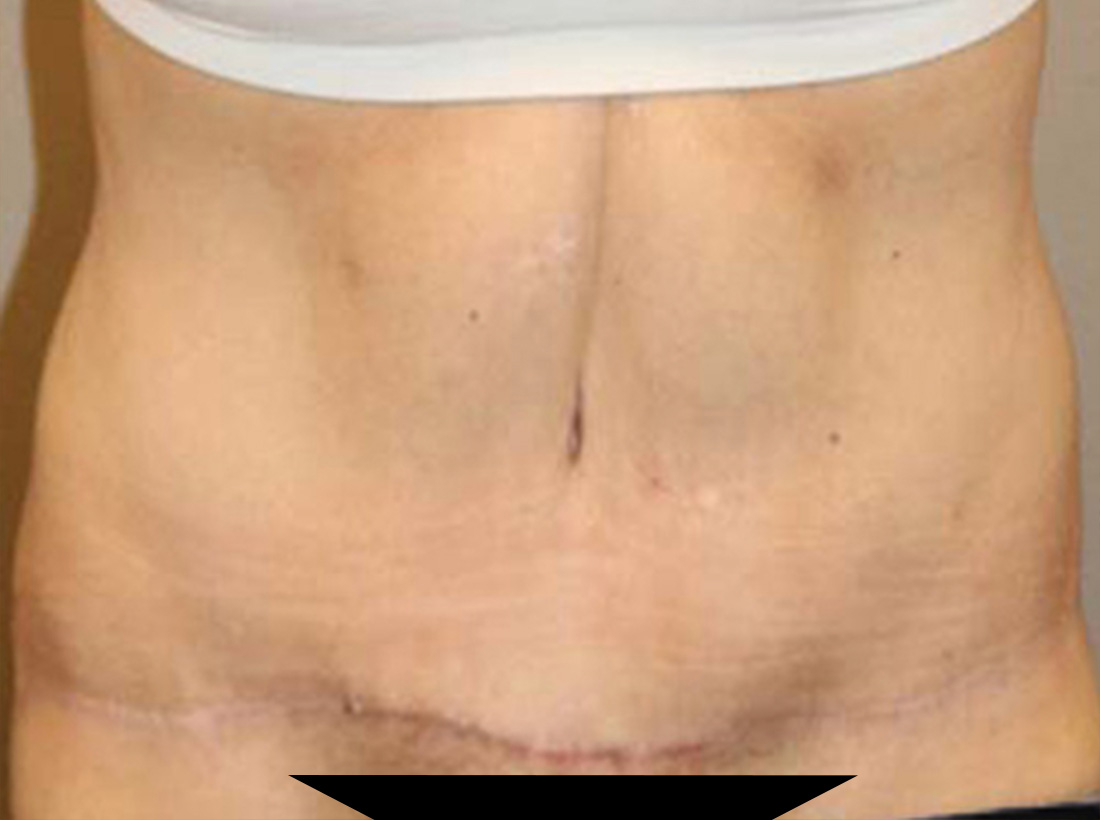 Tummy Tuck Before and After 18